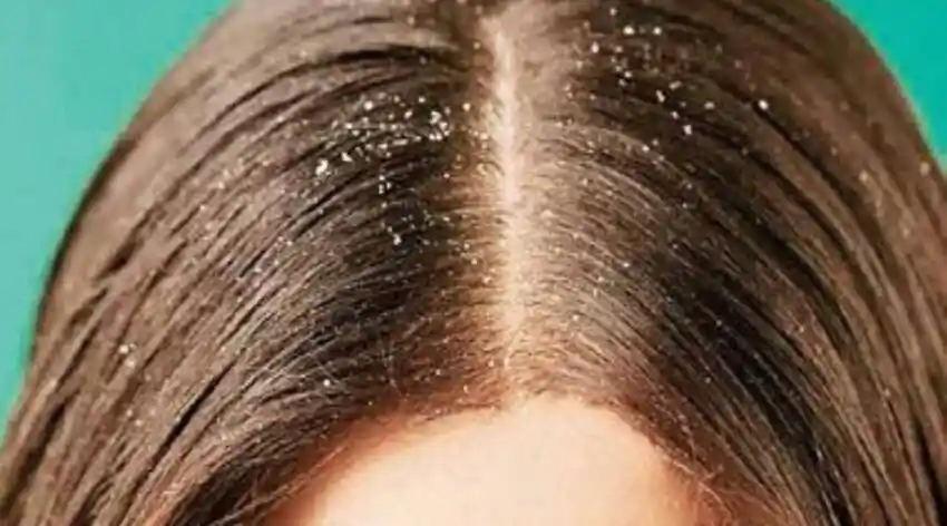 सर्दियों में डैंड्रफ से हैं परेशान, तो आजमाएं ये घरेलू नुस्खे; रूसी से मिल सकता है छुटकारा